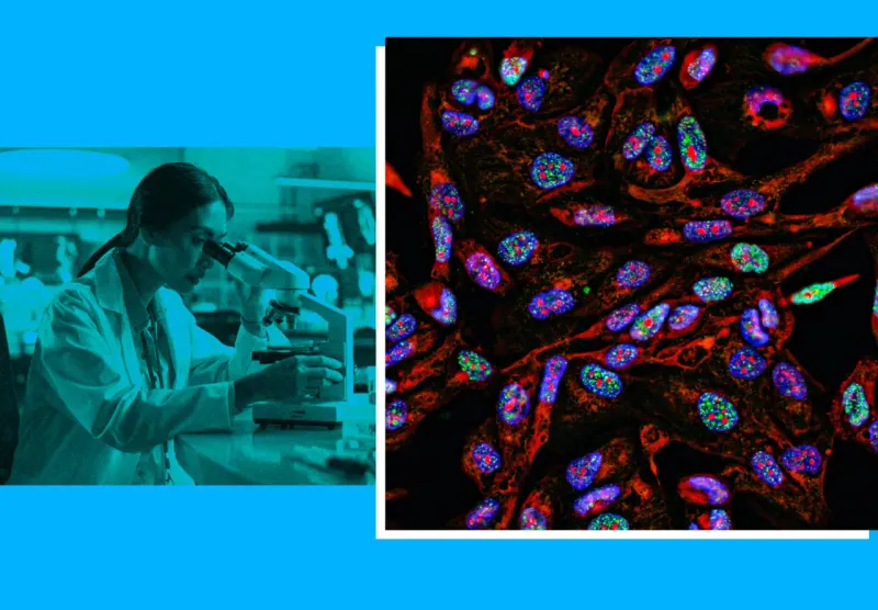 A glowing RNA needle punctures an inflated skin lesion, symbolizing cancer-treatment promise and fears of hype.